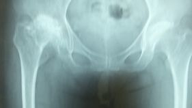 股関節のレントゲン画像 …変形性関節症の程度を確認